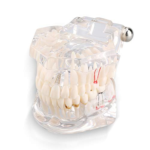 Zahnmodell - Dental Teaching Study Adult Demonstration, Demonstratives Implantatmodell und festsitzender Zahnersatz auf dem Implantat von MLMLH