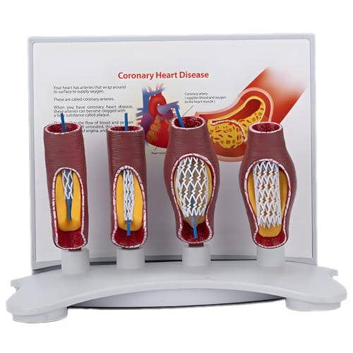 Mavdecll Menschliches Gefäßstent-Modell, Koronar-Stent-Modell, Demonstration Der Blutgefäßvergrößerung, Lehrmodell Für Kardiovaskuläre Okklusion, Für Die Unterrichtspräsentation von Mavdecll