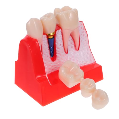 OKUMEYR Enlarged Teeth Teaching Model Realistic Bridge Demonstration Aid For Students Training Classroom Portable Visualization Tool OKUMEYR Enlarged Teeth Teaching Model Realistic Bridge Demonstration Aid For Students Training Classroom Portable Visualization Tool von OKUMEYR