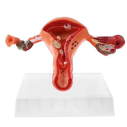 RSBFER Menschliches pathologisches Uterus-Eierstockmodell, anatomisches Modell mit Querschnittsstruktur für die Demonstration des Schulunterrichts, pädagogisches Werkzeug von RSBFER