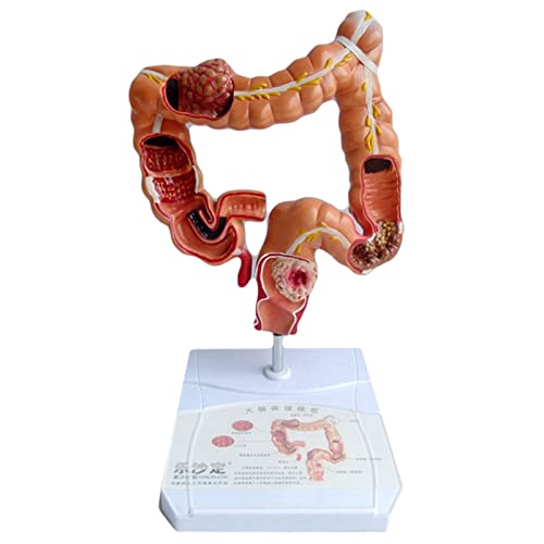 UPIKIT Menschlicher Dickdarm Anatomisches Modell Dickdarm-Pathologie Modell PVC Viszerale Läsion Modell Menschliche Anatomie Anatomie Verdauungsapparat Studieren Lehre von UPIKIT