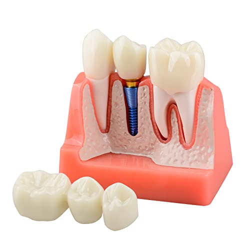 Dental-Implantatmodell mit Kronensteg und abnehmbaren Kronen für die Bildung - normal von Ultrassist
