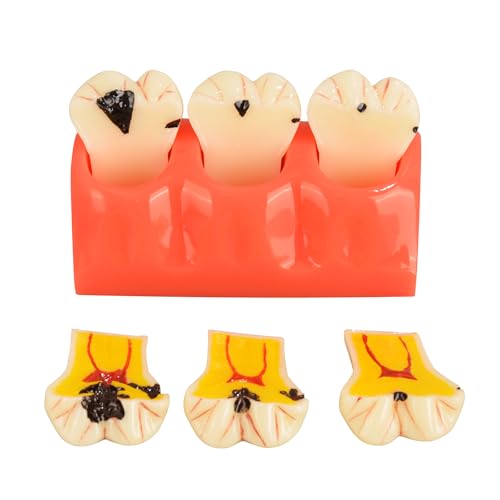 Ultrassist Dental Caries Teeth Model 4 Times Dental Tooth Decay Model Caries Bilateral Comparison Pathology Model Teeth for Dental Education Supplies, Tooth Pathology Display Ultrassist Dental Caries Teeth Model 4 Times Dental Tooth Decay Model Caries Bilateral Comparison Pathology Model Teeth for Dental Education Supplies, Tooth Pathology Display von Ultrassist