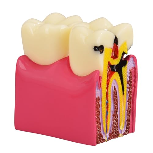 Ultrassist Dentales Zahnkariesmodell, 6-maliges Zahnkaries-Zahnmodell, Karies-bilateraler Vergleich, Pathologiemodell, Zähne für zahnmedizinisches Unterrichtsmaterial, Zahnpathologie-Anzeige von Ultrassist