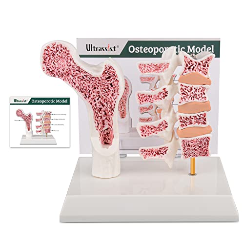 Ultrassist Osteoporose-Modell, menschliche Wirbel, anatomisches Modell für die Unterrichts-Demonstration mit Lernkarte von Ultrassist