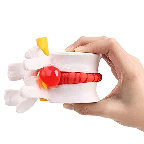 Lendenwirbel-Modell, menschliches anatomisches Lendenwirbel-Bandscheibenvorfall-Modell Medizinisches Lernhilfe-Demonstrationsmodell von WJYLM