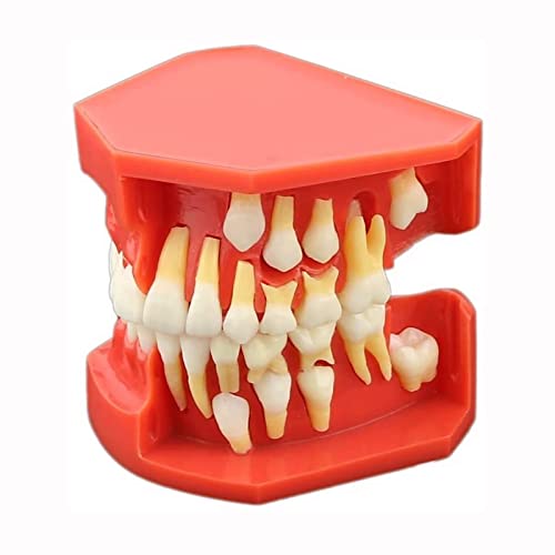 Dental Teeth Study Teaching Model, Disease Removable Demonstration Model 9-12 Year Old Child Care von WXLWHR