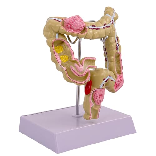 Humanes Dickdarmmodell Menschliche Pathologien Des Lavy Darm Modells Für Medizinische Unterrichtsinstrumente Für Die Laborschule Studie Humanes Dickdarmmodell Menschliche Pathologien Des Lavy Darm Modells Für Medizinische Unterrichtsinstrumente Für Die Laborschule Studie von YCHUCH