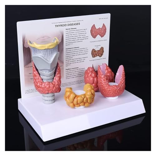 Schilddrüsen-Anatomiemodell – Schilddrüsenknoten-Modell, 3:1, das das pathologische Verdauungssystem der Schilddrüse zeigt, Anzeigestudie, Lehrmittel for anatomisches Modell des menschlichen Körpers von YTUK