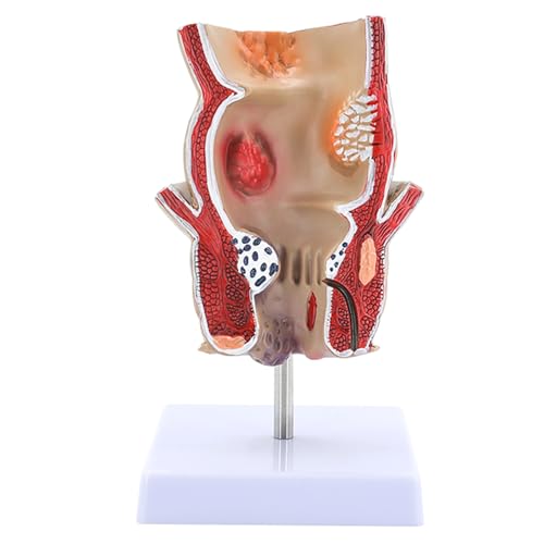Human Pathologies of Rectum Model Human Rectum Model Human Anatomical Model Medicals Teaching Tool for Teaching von Zqxnt